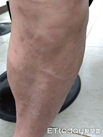 皮肤痒红疙瘩湿疹怎么治疗,湿疹红斑发痒怎么消除