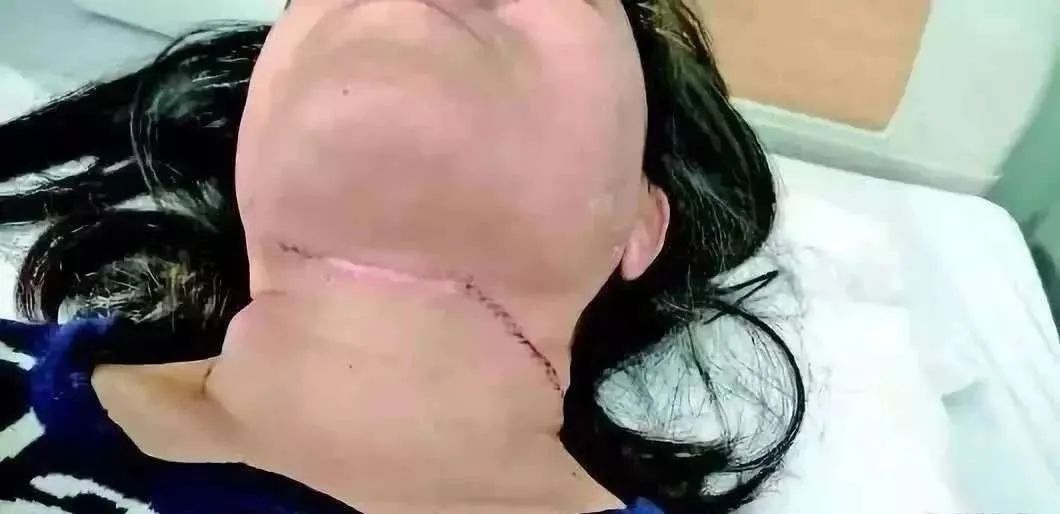 春天里，这个东西竟成了“夺命利器”！伤人割喉仅在一瞬间