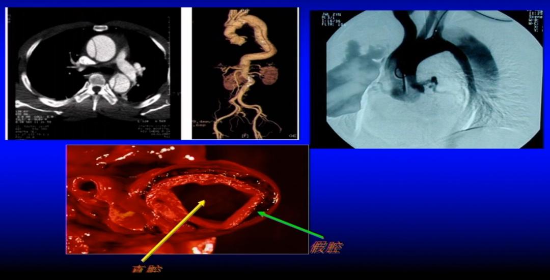 急性胸痛的理论知识,一图牢记急性胸痛的诊断流程
