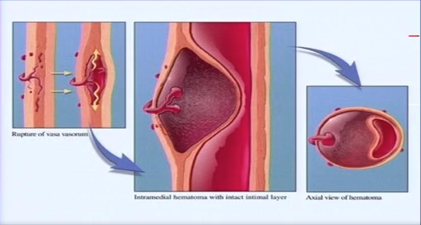 胸痛急救知识点,急性胸痛的诊断思路