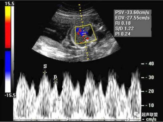 胎儿宫内窘迫通过什么检查出来的,胎儿宫内缺氧的超声视频