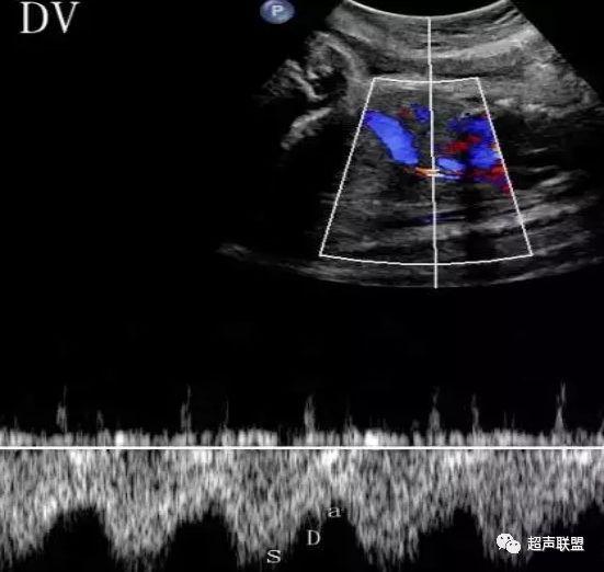 胎儿宫内窘迫通过什么检查出来的,胎儿宫内缺氧的超声视频