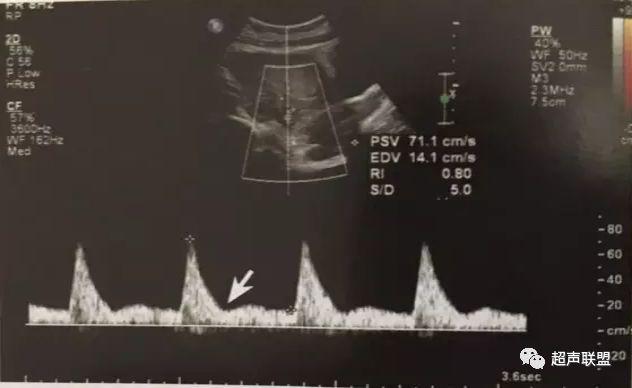 胎儿宫内窘迫通过什么检查出来的,胎儿宫内缺氧的超声视频