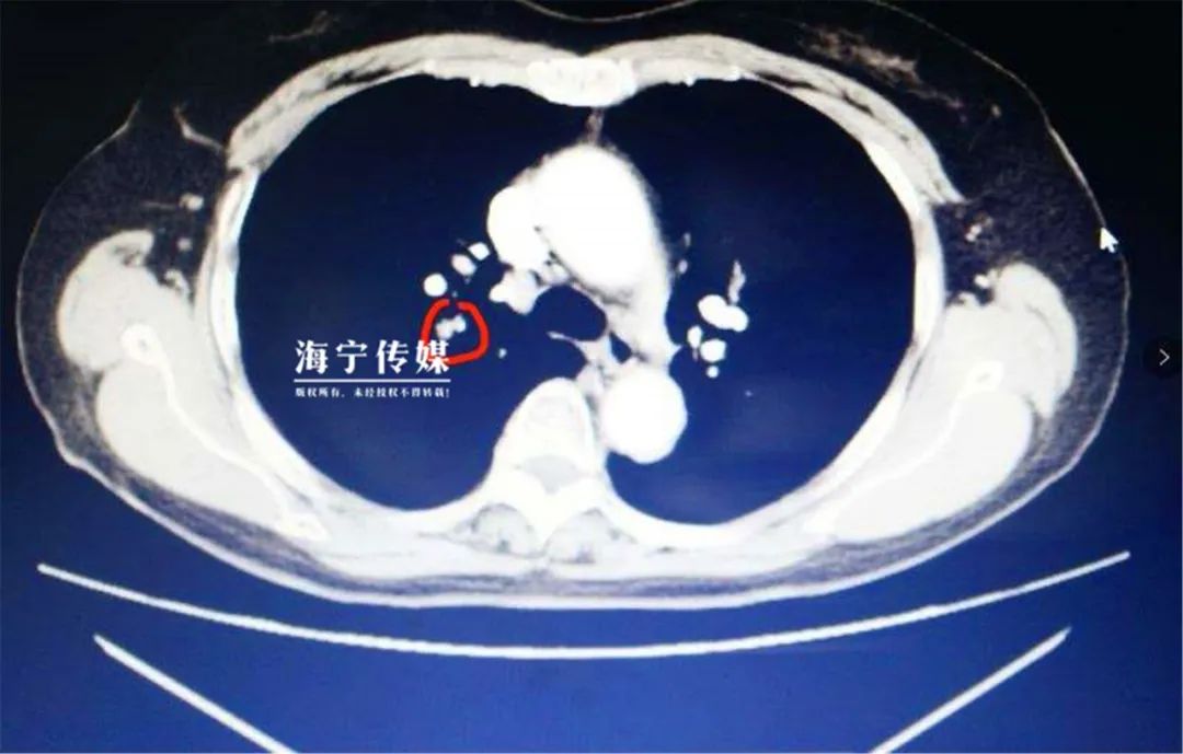 走路崴脚后第一时间咋处理,崴脚后第几天能走