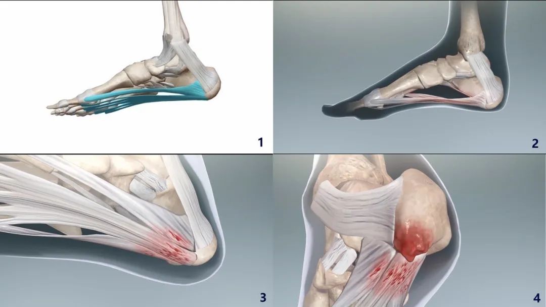 骨刺会恶化吗,骨刺是不可逆损伤吗