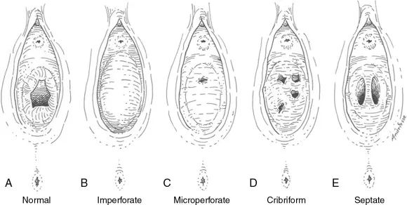 卫生棉条到底好不好用,卫生棉条是什么为啥大家都不敢用