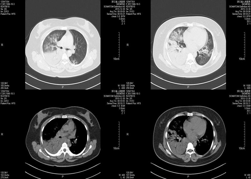 反复发热肺里有痰,干咳是肺部感染引起的吗