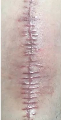 瘢痕体质留疤了怎么办,只有开刀才长疤是瘢痕体质吗