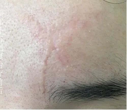 瘢痕体质留疤了怎么办,只有开刀才长疤是瘢痕体质吗