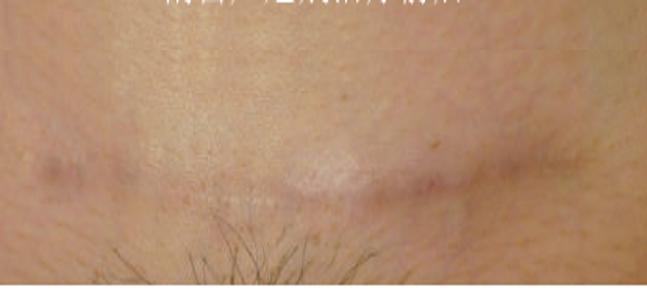 瘢痕体质留疤了怎么办,只有开刀才长疤是瘢痕体质吗