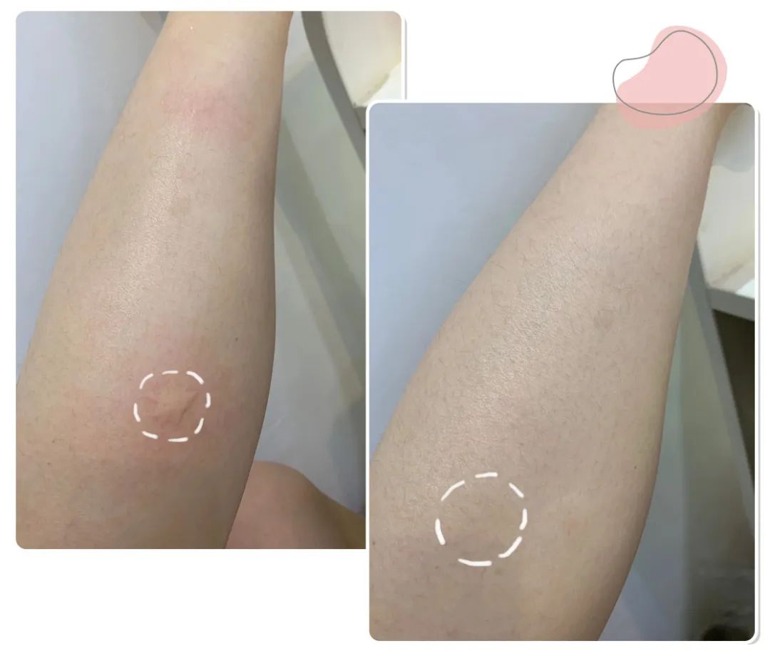 喷花露水驱蚊止痒,黄圣依代言的保湿防晒喷雾