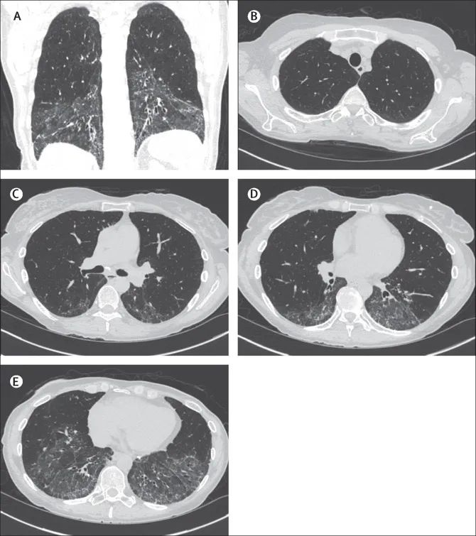 一文总结：系统性硬化症相关间质性肺病的诊断和管理|临床实战