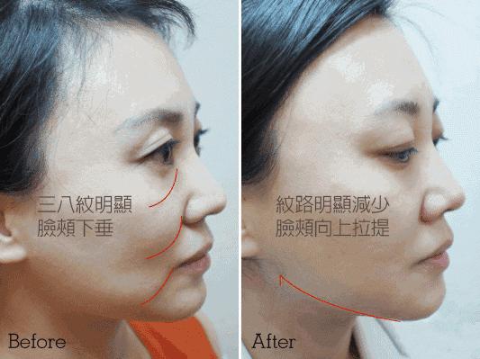 长期补充胶原蛋白的人怎么样了,长期喝胶原蛋白的人最后怎么样了