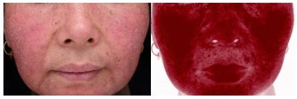 最近的脸又痒、又红、还发烫,华西专家说,你多半是遭了敏感性皮肤了!