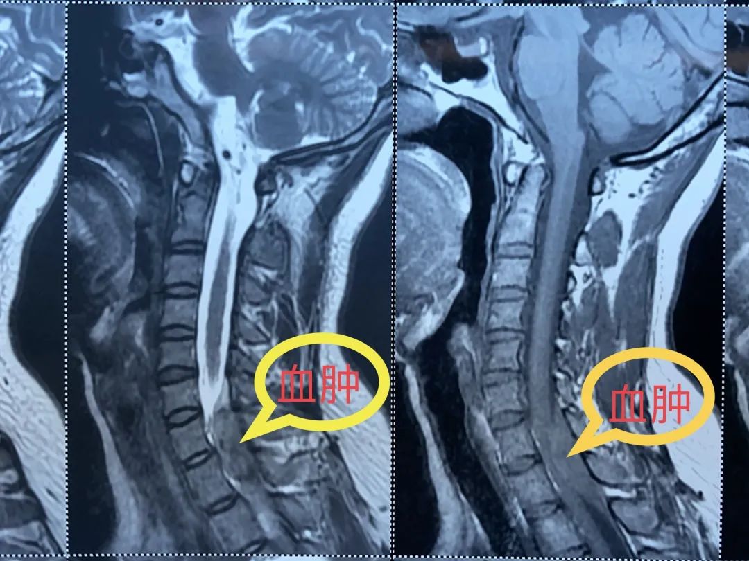 脖子酸痛做哪些动作,警惕脖子酸痛这样做严重可致瘫痪