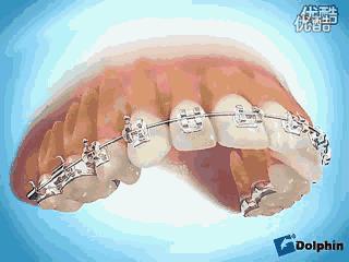 矫正牙齿的最佳年龄和价格表,孩子矫正牙齿多大年龄最合适