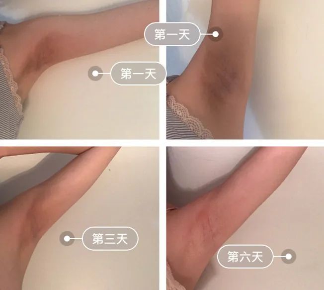 啤酒消痘痘,喝啤酒会消除痘痘吗