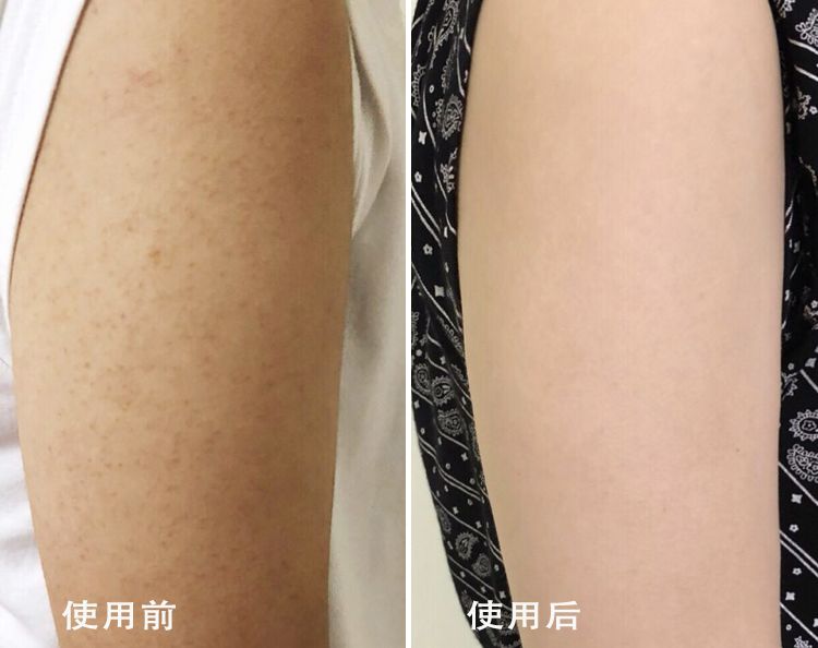 别放弃，烦人的“鸡皮疙瘩”，真的还可以再救一下