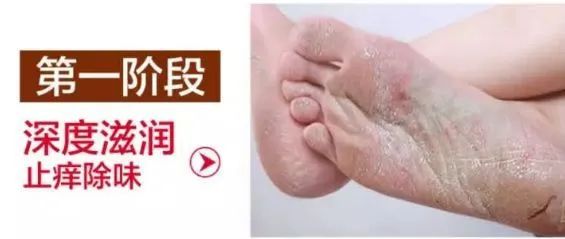 冬天脱鞋脚臭怎么办,长时间没办法脱鞋怎么防止脚臭
