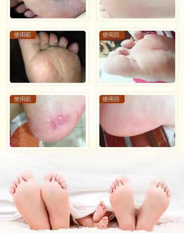 脚臭脱鞋多久可以去味,脱鞋臭脚怎么快速除臭