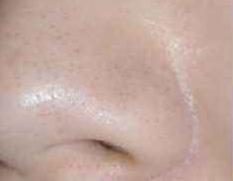 超微小气泡毛孔吸尘器使用方法,毛孔吸尘器去黑头收缩毛孔