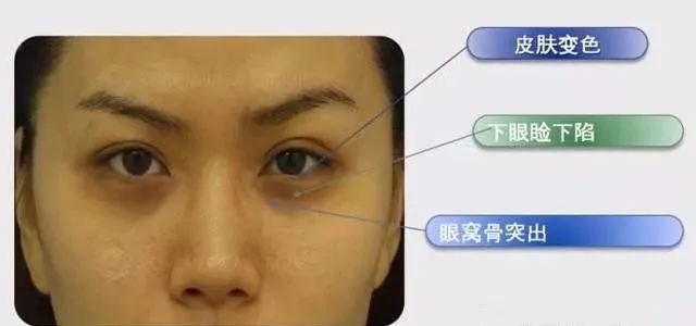 两边黑眼圈程度不一样,黑眼圈的秘密暴露了一个真相