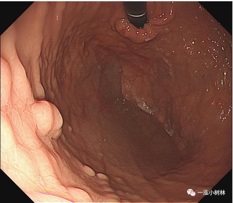 肠上皮化生做什么检查,肠化生内镜看得出来吗
