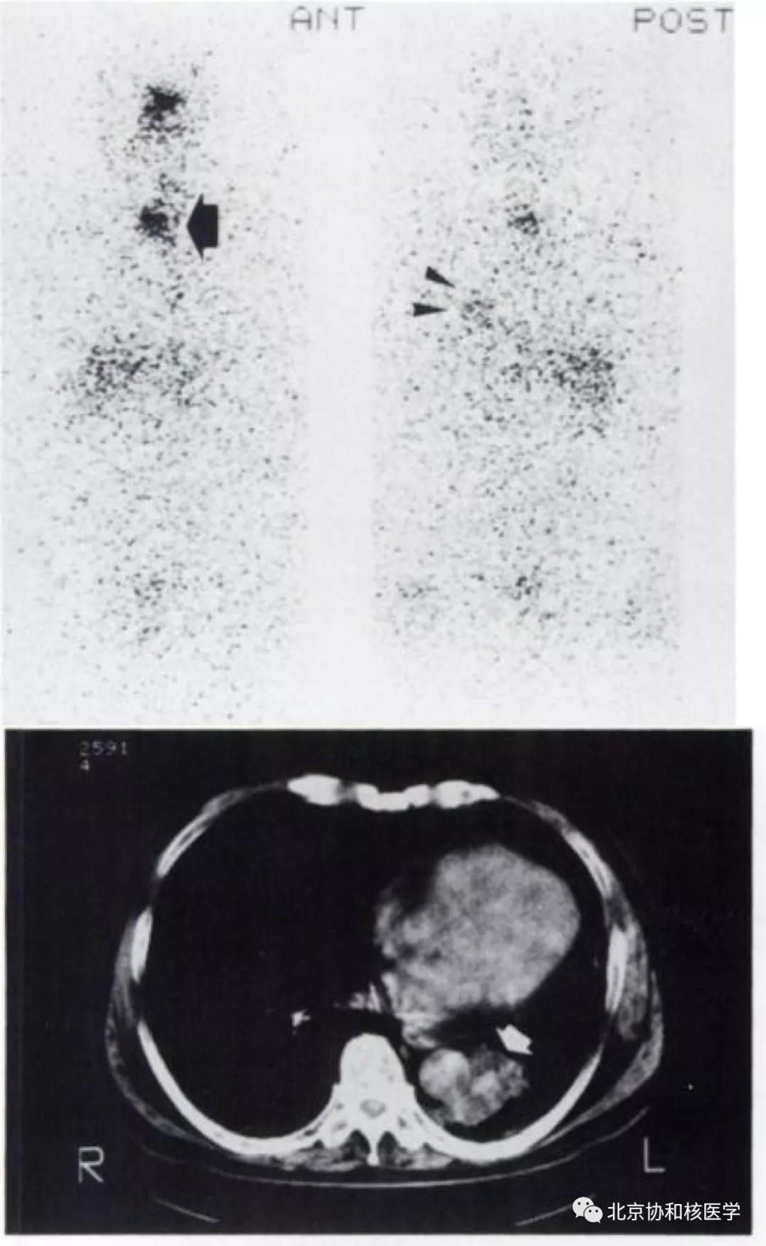碘扫描最坏的结果,放射性核素扫描可以鉴别诊断吗