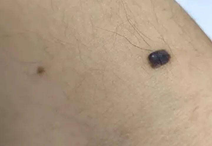黑痣癌变的痣会很大吗,黑痣癌变一般是一个痣还是好多