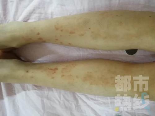 西安7岁女孩吃了一串烤鱿鱼致旧疾复发，医生提醒：这类人远离海鲜产品