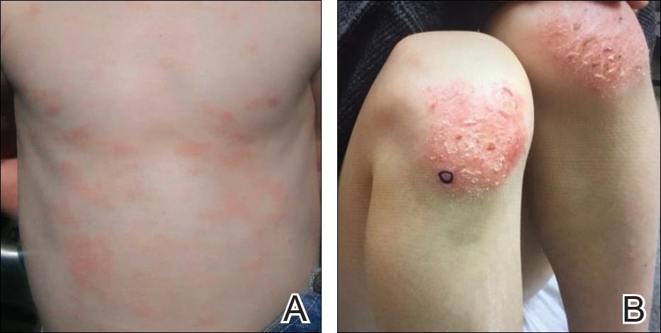 女儿皮炎医生要求打度普利尤单抗,度普利尤单抗治疗儿童特应性皮炎