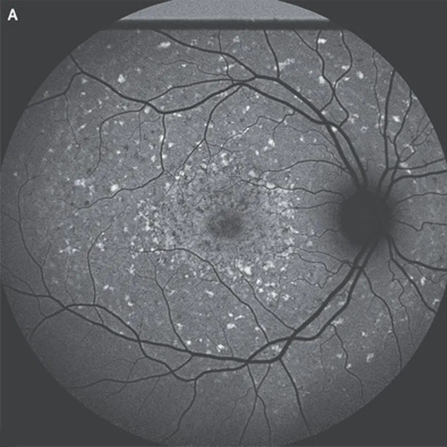 早发性黄斑变性,干性老年性黄斑变性简称
