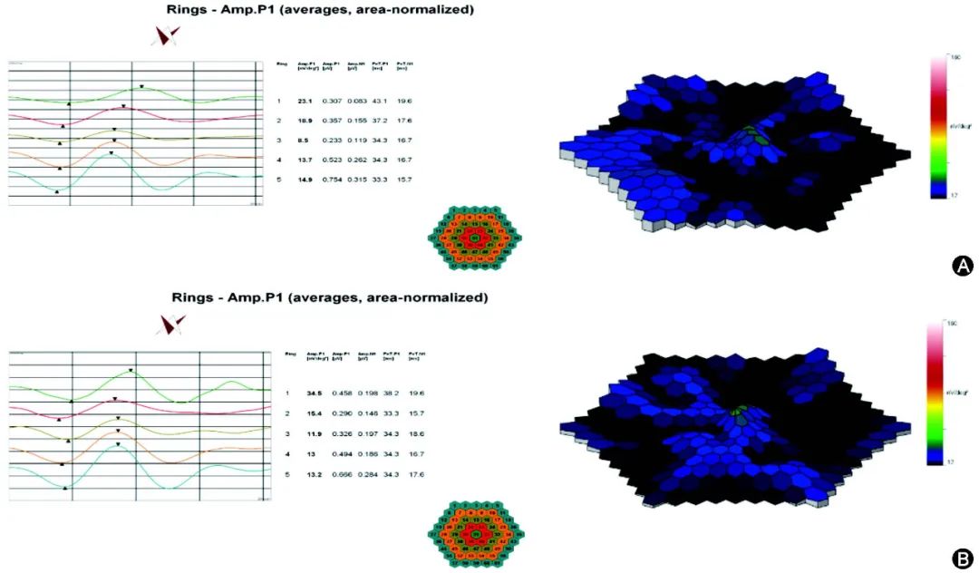早发性黄斑变性,干性老年性黄斑变性简称