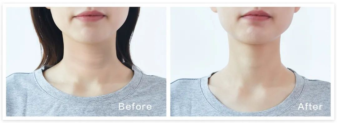 女人脖子有颈纹和年龄有关吗,一条颈纹代表二十岁