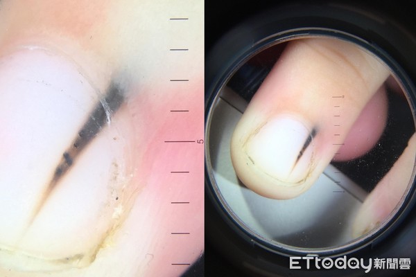 指甲上黑线重大疾病,指甲一条棕黑色竖纹什么病