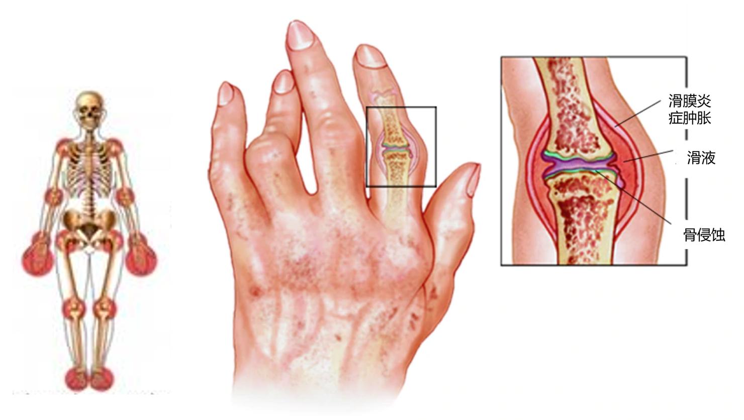 有类风湿症状没有类风湿因子,不是类风湿病吃类风湿药有啥症状