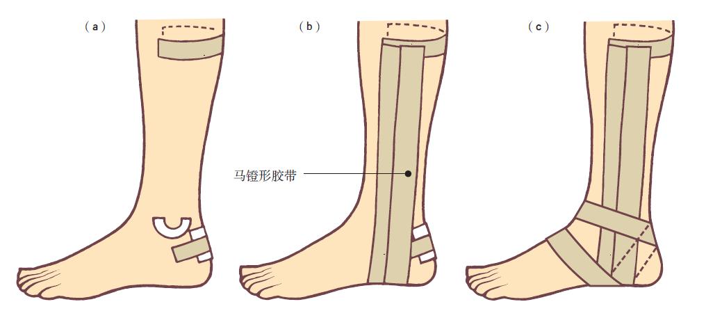 踝关节损伤的处理7条助你应对,踝关节韧带损伤多久能恢复正常