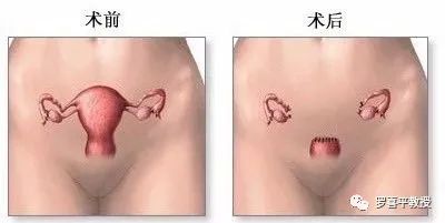 一个女人，切了子宫会变成什么样？