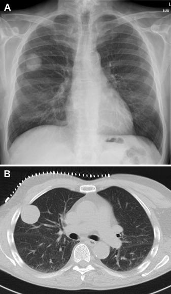老人左乳房下胸痛,老人胸部结节痛