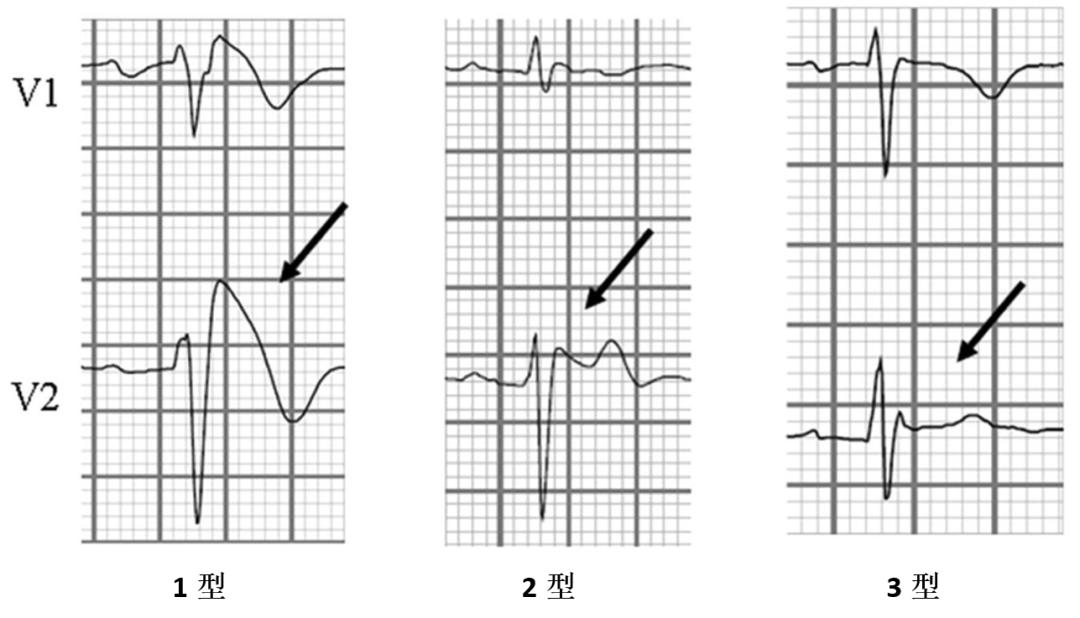 三兄弟接连变痴呆去世,三兄弟遭害后续