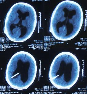 脑积水腹腔分流术后头晕头痛,脑积水分流术后发烧会有什么后果