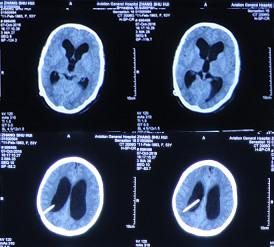 脑积水腹腔分流术后头晕头痛,脑积水分流术后发烧会有什么后果