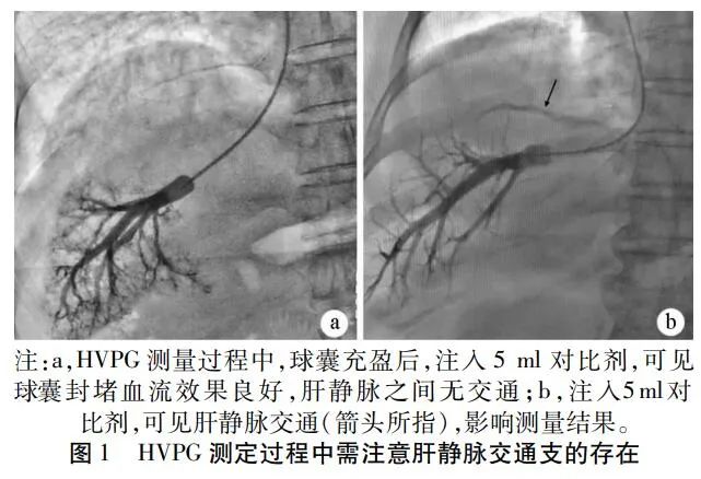 肝硬化压力梯度,肝静脉压力梯度测定前的准备