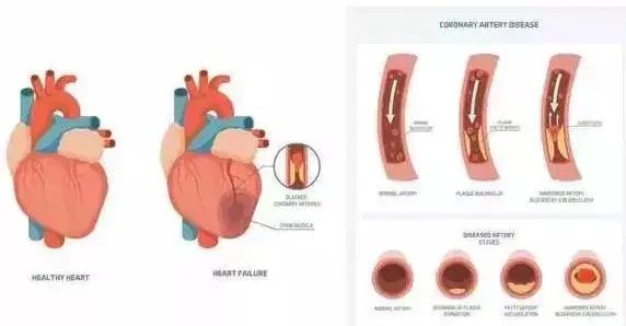 34岁北大博士心梗猝死,国世平老师突发心梗