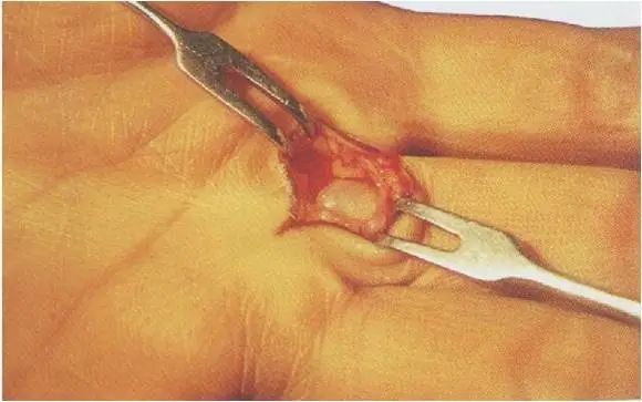 膝盖腱鞘囊肿最快的恢复办法,脚趾腱鞘囊肿会癌变吗