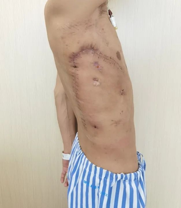 用他自己的肌肉塞进胸腔?甘肃农民为治病跨越大半中国,最终在杭州得救