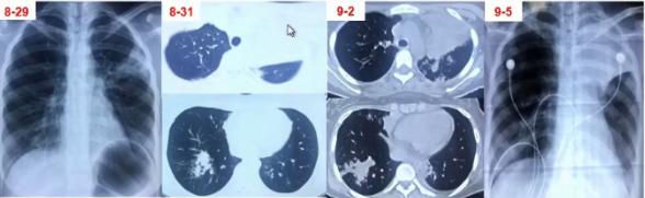 支原体肺炎症状中医诊治,成人肺炎支原体肺炎诊治专家共识