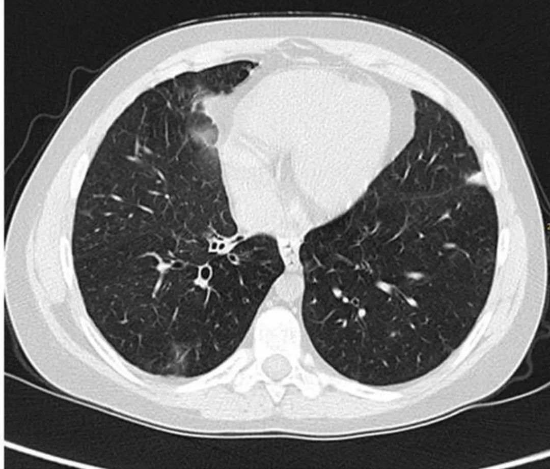 lr858基因突变,lrba基因