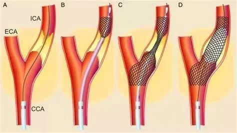 世界脑卒中日活动流程,世界卒中日警惕症状尽早识别救治