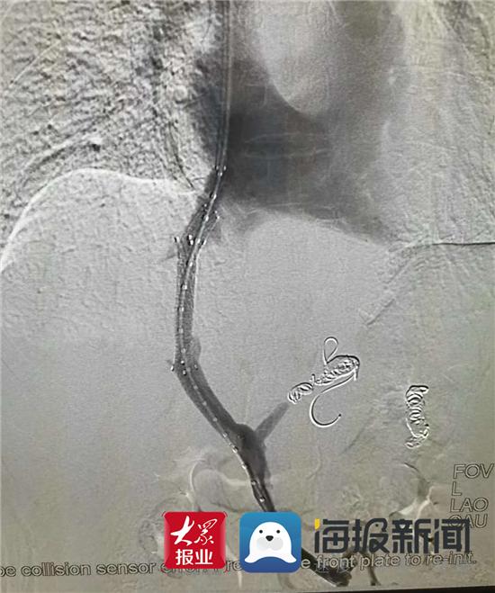 万杰医院手术成功率,万杰青医生做介入技术如何